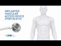 Port-a-Cath Implanted Vascular Access Device