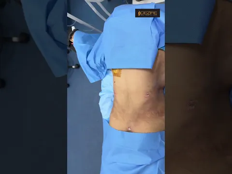 Upper Back, Lower Back Liposuction Result