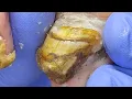 Lagu Extra Thick Yellow Nails, Growing In Layers, Carefully Trimmed【Podiatry Clinic】