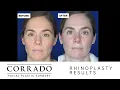 Emotional Rhinoplasty Reveal - Nose Job Surgery Reveal Dr Anthony Corrado