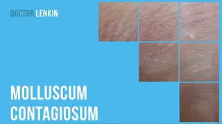  molluscum contagiosum that resembled a sebaceous gland