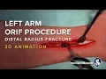 Download Lagu Left Arm ORIF Procedure of Distal Radius Fracture - 3D Medical Animation