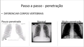 Curso de Radiografia de tórax - Aula I - Analisando radiografia de tórax / Parte 1