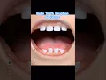 Baby Teeth Eruption Sequence