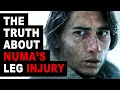 Numa Turcatti s Leg Injury Didn t Happen That Way The Real Story Society of the Snow