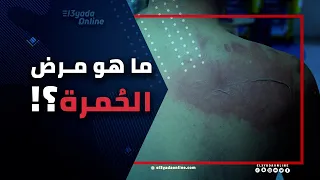 مرض الحمرة أعراضه واسبابه وطرق العلاج 