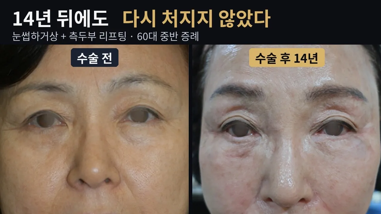 눈썹하거상 14년 후, 윗눈꺼풀은 어떻게 되었을까 | 측두부 리프팅·미간주름#눈썹하거상 #윗눈꺼풀처짐 #측두부리프팅 #미간주름 #상안검 #자연미TV