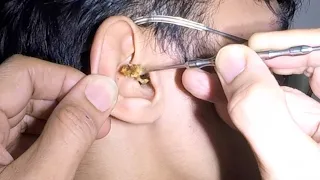 One Large EARWAX Stuck in Man's Ear