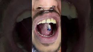 زراعة سن أمامي رائع    زراعة الاسنان دندنها