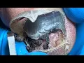 Lagu There Is A Lot Of Blood Inside The Toenails, Clean Carefully【Pedicure Master Lin Jun】
