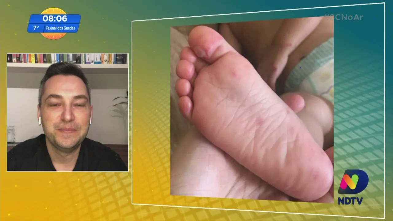 Síndrome Mão-Pé-Boca é comum em crianças com menos de cinco anos