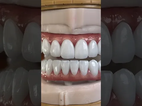 Nuevas Prótesis fijas sobre implantes - Híbridas tipos Toronto y Blender