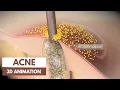 Download Lagu Acne basics | Pathophysiology \u0026 Treatment  | 3D Animation