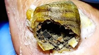 Onychomycosis Protrudes Like A House, With Mold Inside【Xue Yidao】