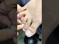 Nail Edge Care and Treatment ep13