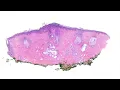Dermpath educational case 25 - how deeper levels can change EVERYTHING