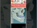 Orthognathic surgery to push lower jaw inside Class 3 jaw