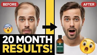 minoxidil 20 month results unbelievable restart minoxidil journey