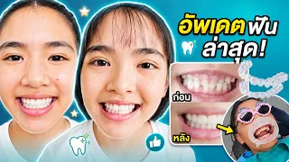 หนูยิ้มหนูแย้ม อัปเดตจัดฟัน! หลังจัดฟันแล้วเปลี่ยนไปแค่ไหน? 🦷✨