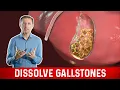 Lagu What Causes Gallstones \u0026 How to Treat Them – Dr.Berg