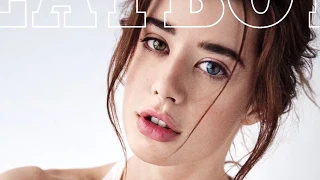 Irex Laser Treats Iris Heterochromia Sarah McDaniel Krotchy