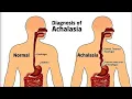 Discuss Esophaeal achalasia cardiac sphincter disorder