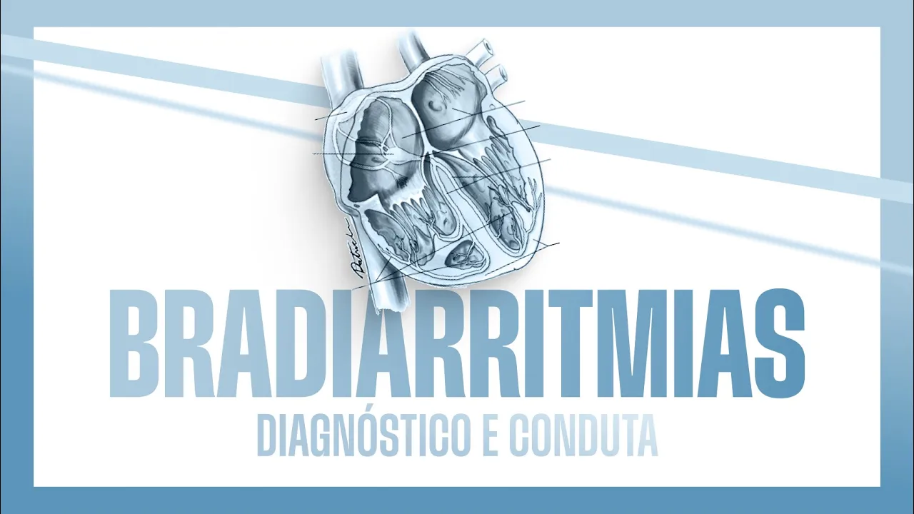 Bradiarritmias - Diagnóstico e Conduta