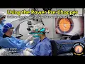 Download Lagu CataractCoach 1105: using the  power pre-chopper (ultra-chopper) with Dr Luis Escaf