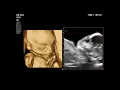Fetal Flat Facies Binder Facies Ashutosh Gupta