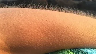 POR QUE NOSSOS PÊLOS ARREPIAM? SAIBA A RESPOSTA [+10]