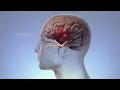 Inside a Migraine The Body s Response to an Attack WebMD