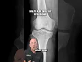 How to Read Knee X-Rays Like a Surgeon