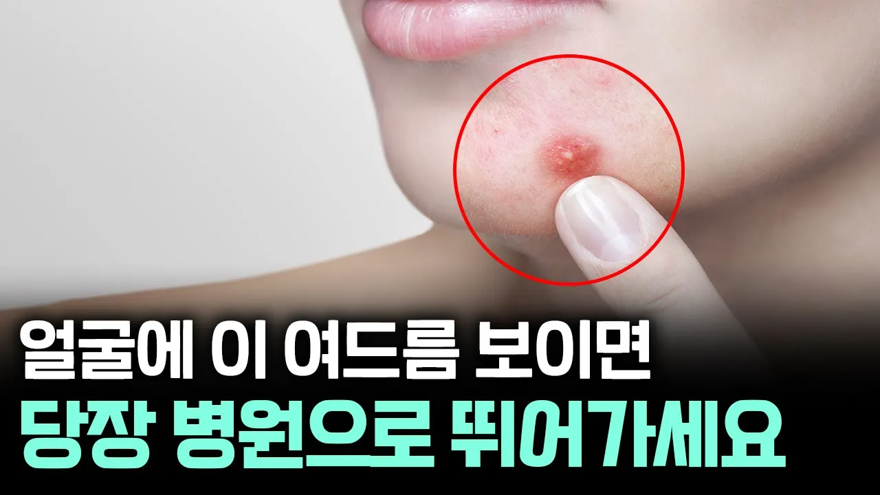 이 여드름 보이는 순간 신발부터 신으세요... 🤔 압출은 이 타이밍 놓치면 흉터 남습니다