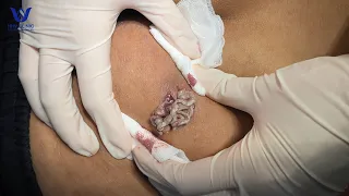 Điều trị mụn u nang bã vùng Mông - Tại phòng khám da liễu HHV Clinic.