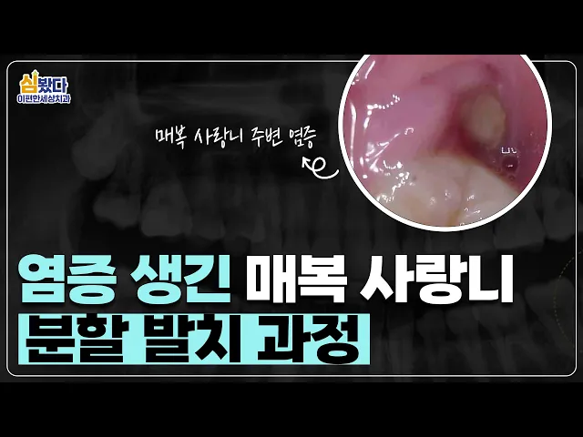 사랑니에 염증이 생긴 경우 어떻게 발치해야 할까? ｜ #매복사랑니 #사랑니염증