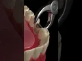 Download Lagu Animated Dental Extraction Procedure