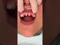 Download Lagu can dental bridges look good? | Dental bridge procedure | missing front tooth fix | Dr. Yazdan