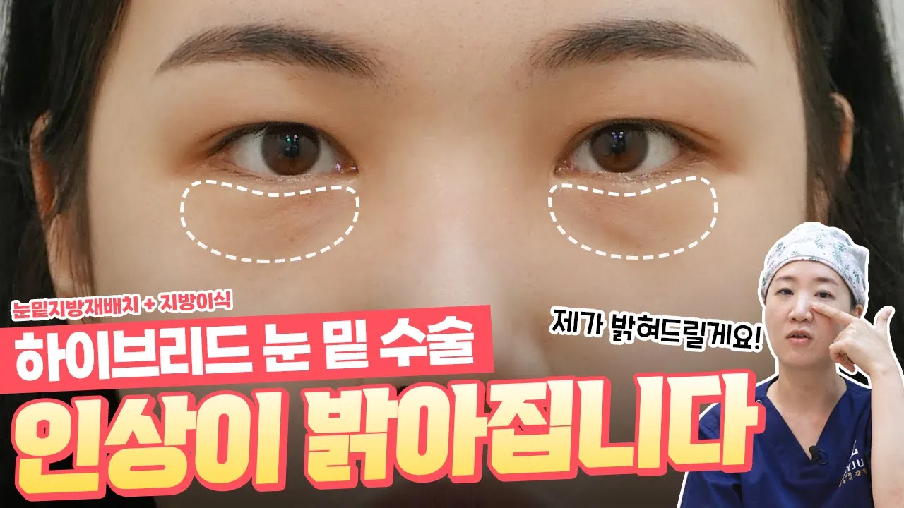눈밑꺼짐, 눈물고랑, 다크서클을 한방에 해결 하고 싶다면! [ 제이준성형외과 하이브리드 눈밑수술]