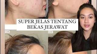 Jujur jujuran tentang BEKAS JERAWAT aku | cara aku pudarin bekas jerawat acne