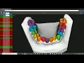 Automated teeth segmentation using Pointcloud-based Deep learning DGCNN