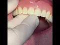 Download Lagu Snap on Dentures