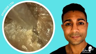 1,731 - Strange Eardrum Appearance After Removal of Pre-Keratosis Obturans Using the iCLEARscope®️