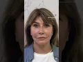 Download Lagu Dr Gustavo Faissal Haidar, caso sensacional de harmonização facial!