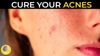 home remedies for acne 