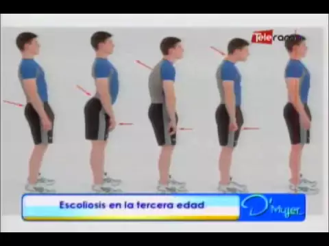 Escoliosis en la tercera edad