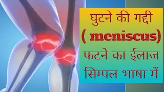 Meniscus Injury in Hindi/घुटने की गद्दी फटने का ईलाज हिंदी