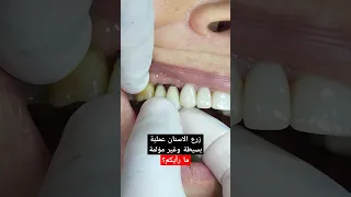 زرع الاسنان عملية بسيطة 