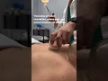 Fire Cupping Would You Try This