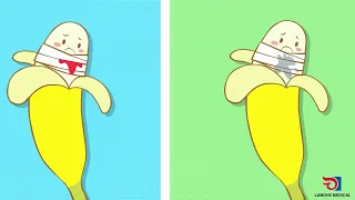 شاهد كيف تتم عملية ختان الذكور الطهارة Circumcision Procedure 