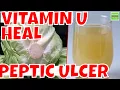 Download Lagu PEPTIC ULCER Vitamin U HEAL Peptic Ulcer in 10 days MP3